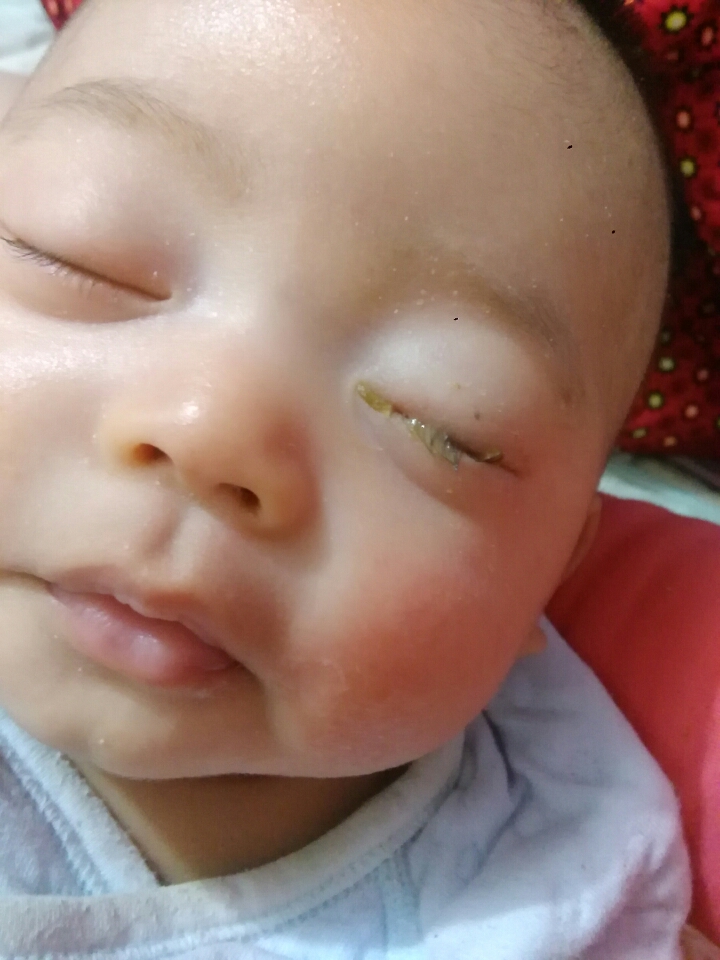 宝宝老是有眼屎怎么回事