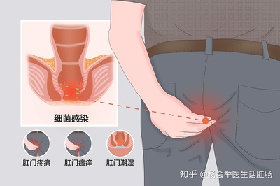 肛窦炎怎么治疗