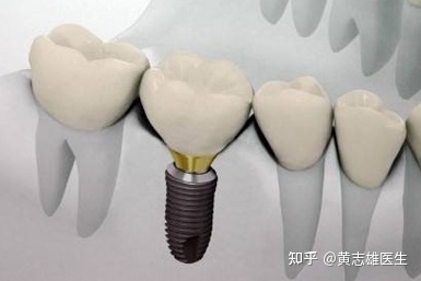 烤瓷牙步骤