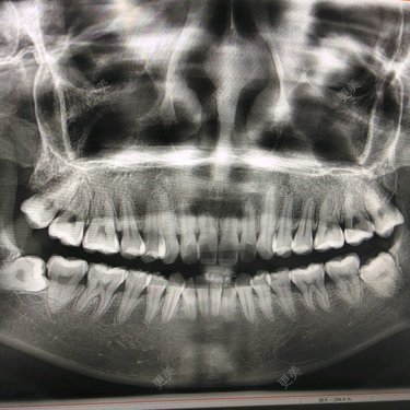 口腔拍片多久可以怀孕