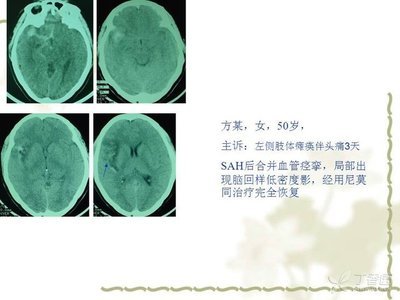 蛛网膜下腔少量出血怎么治疗