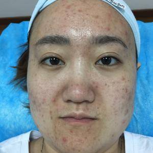 满脸痘痘用什么牌子