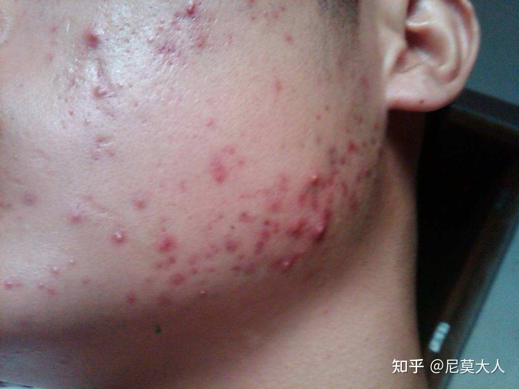 青春期长痘痘怎么
