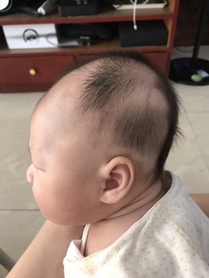 新生儿头有点尖怎么办