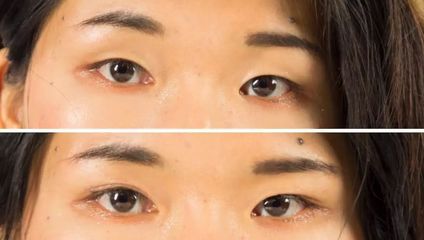 拉双眼皮