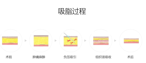 抽脂融脂