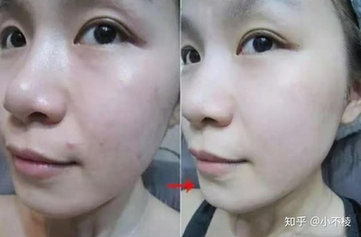 脸上有痘痘适合什么精华