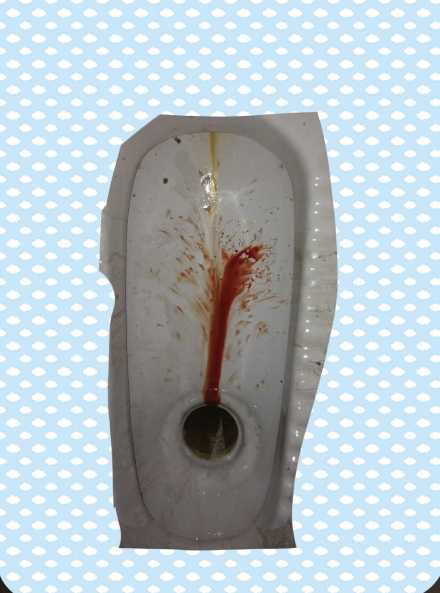小便出血是怎么回事男