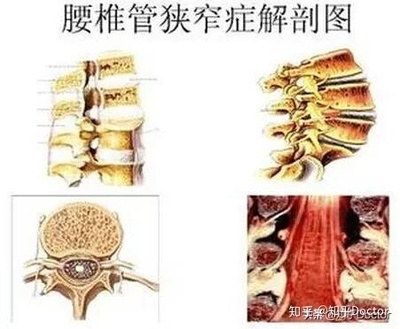 腰椎狭窄怎么治疗效果最好