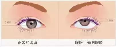 内眦赘皮双眼皮