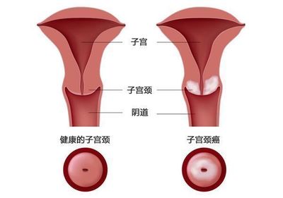宫颈肿瘤怎么治疗