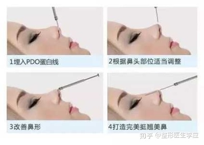 线雕隆鼻一包多少根线