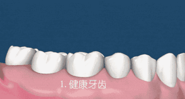 牙齿缝的结实怎么治疗
