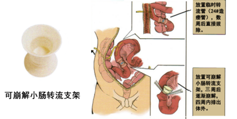 大肠回纳术费用多少