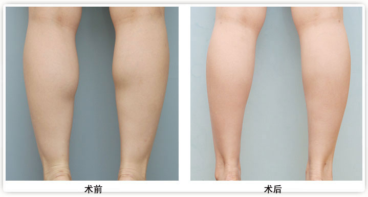 打botox瘦腿针效果好不好