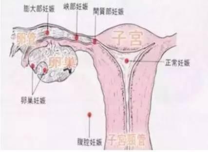 输卵管造口术后怀孕率
