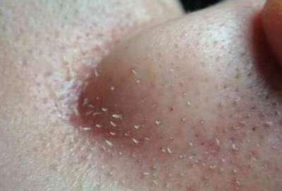 粉刺挤掉好还是不挤好