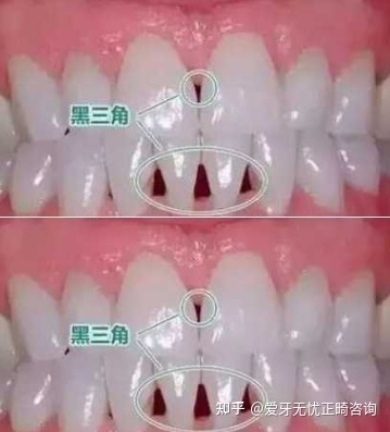 牙齿矫正脸凹陷