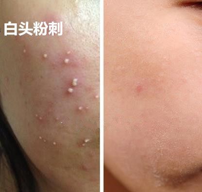 嘴上有痘痘