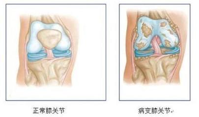 膝关节困疼是怎么回事