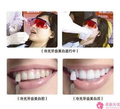 牙齿美白的副作用