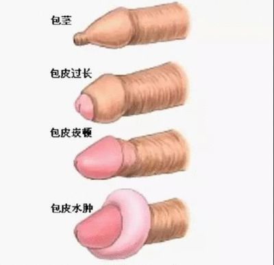 包皮浮肿是怎么回事