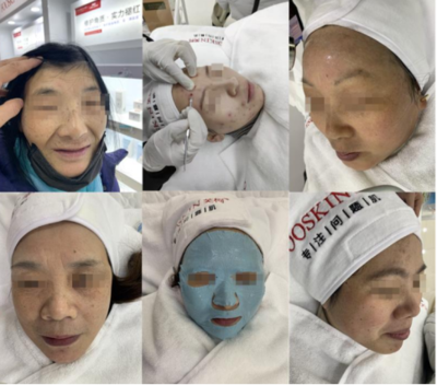南通痘痘中医