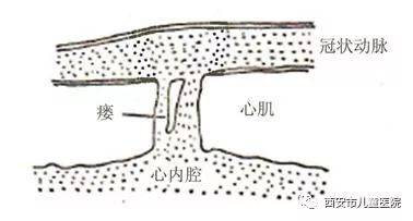 冠状动脉瘘怎么治疗