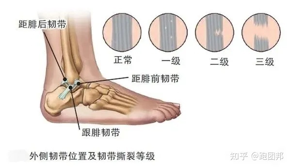脚外侧疼是怎么回事