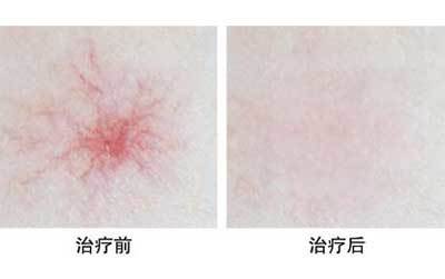蜘蛛痣怎么治疗