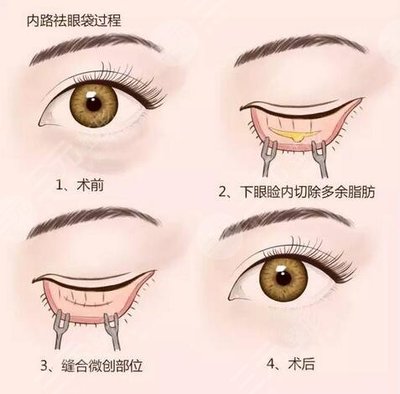 广西眼部整形