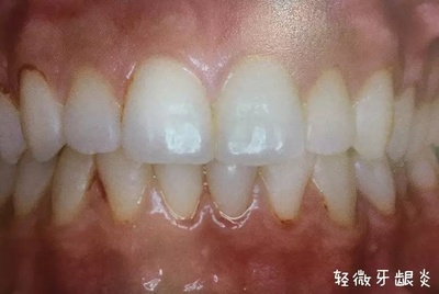 牙周炎早期怎么治疗