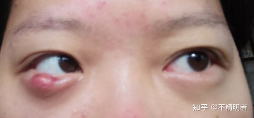 碘伏痘痘