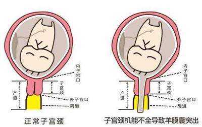 孕妇宫颈长度