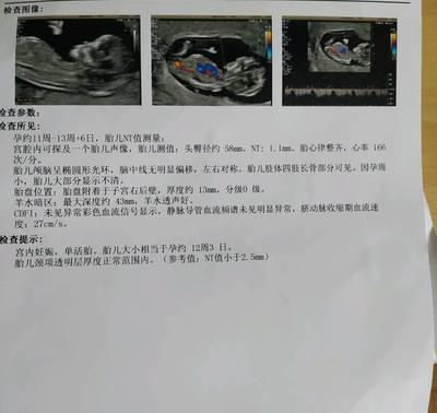查白带可以查出怀孕吗