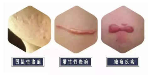 怎么确定是不是疤痕体质