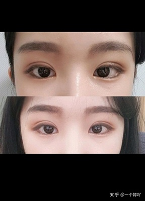 双眼皮可以自己拆线吗