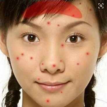 女人痘痘是指哪里