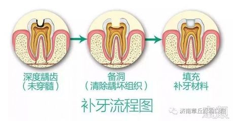 补牙注意