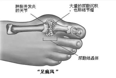 膝盖疼肿怎么治疗