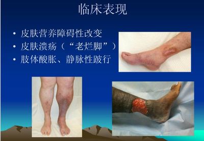静脉曲张前期怎么治疗
