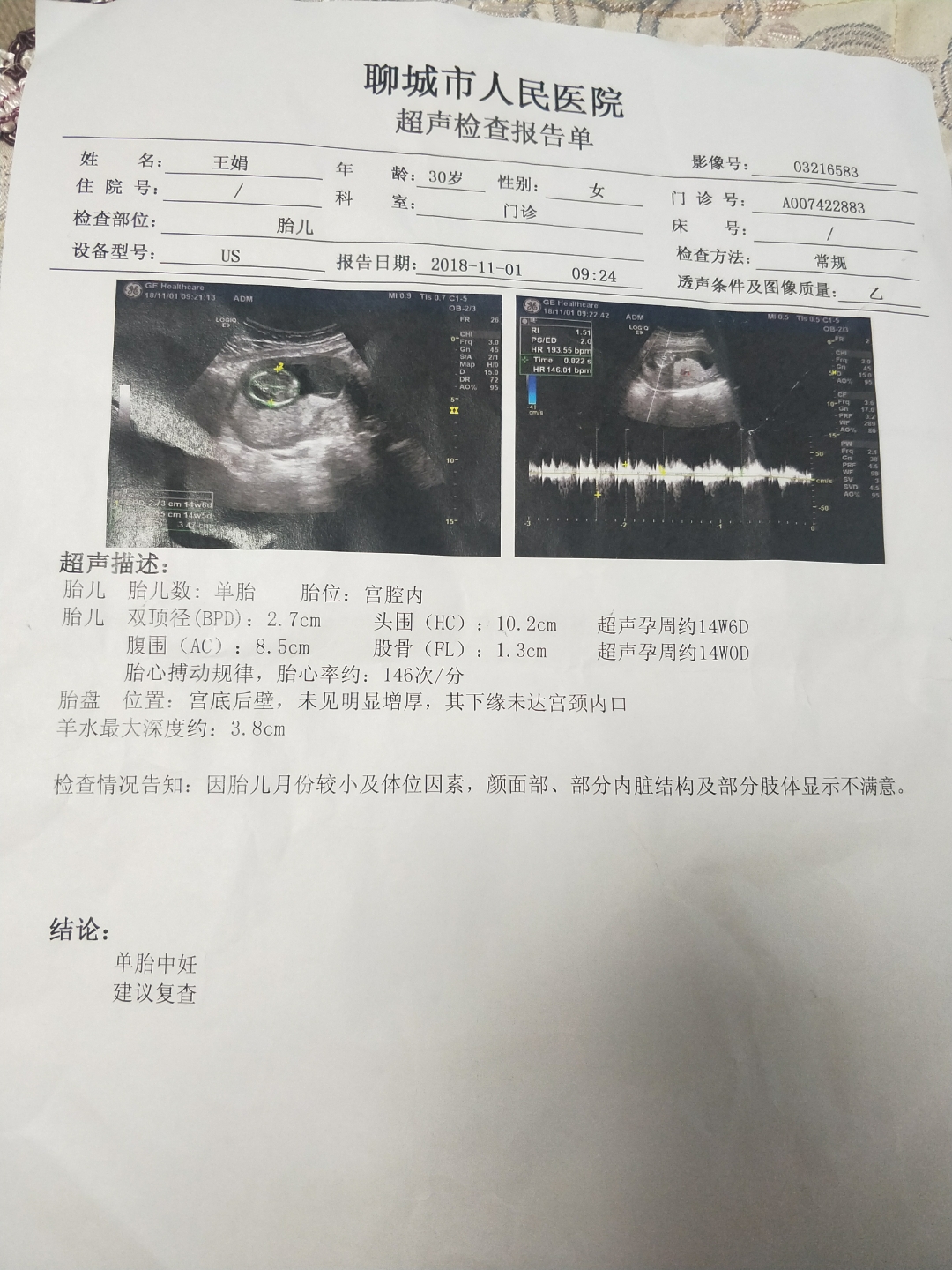 孕酮吃多了对胎儿有影响吗
