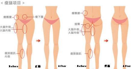 怎么快速瘦肌肉腿