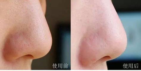 挤痘痘后毛孔粗大怎么办