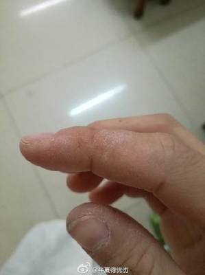 手指上起皮是怎么回事