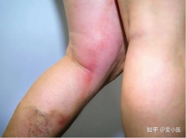 上肢肿胀是怎么回事