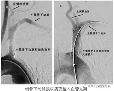 椎动脉血管狭窄怎么治疗