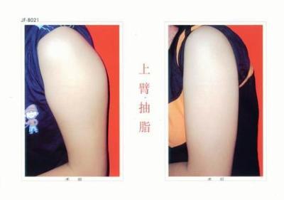 抽脂痛不痛