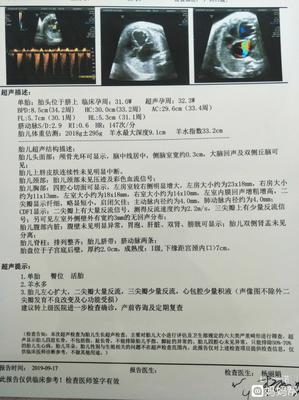 胎儿心包腔少量积液