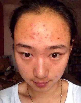 痘痘要好的征兆